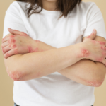 Dermatitis y psoriasis afectan cuerpo y mente