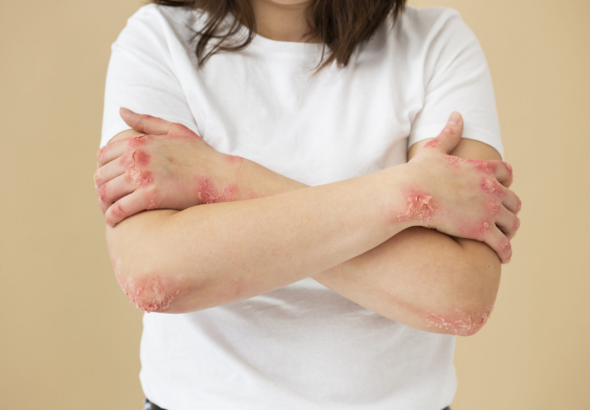 Dermatitis y psoriasis afectan cuerpo y mente