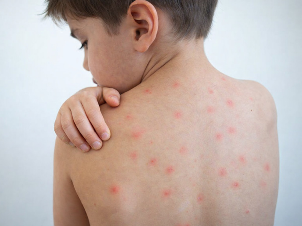 Minsal confirma 11 casos de sarampión y lanza campaña preventiva