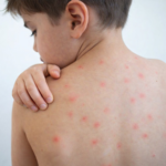 Minsal confirma 11 casos de sarampión y lanza campaña preventiva