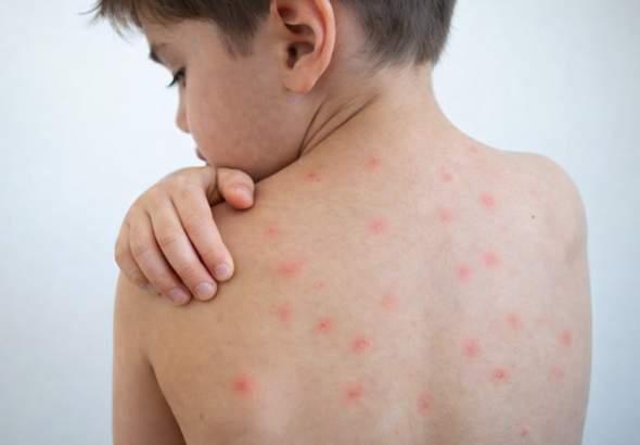 Minsal confirma 11 casos de sarampión y lanza campaña preventiva