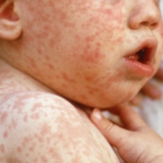 El Salvador mantiene control del sarampión pese a aumento de casos en la región