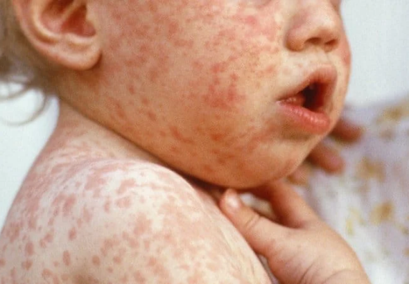 El Salvador mantiene control del sarampión pese a aumento de casos en la región