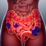 Endometriosis y salud intestinal: cinco señales que no debes ignorar