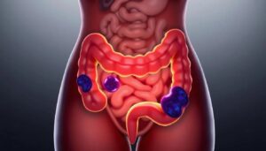 Endometriosis y salud intestinal: cinco señales que no debes ignorar