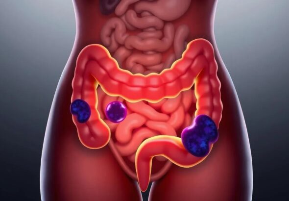 Endometriosis y salud intestinal: cinco señales que no debes ignorar